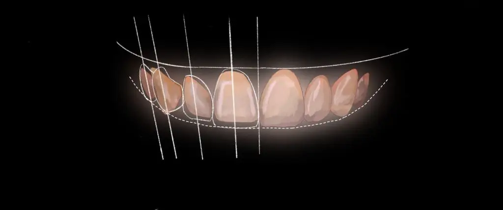 diseño de sonrisa dentaltepox brackets